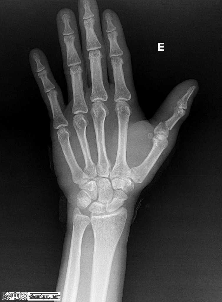 近节指骨骨折 - 拇指
