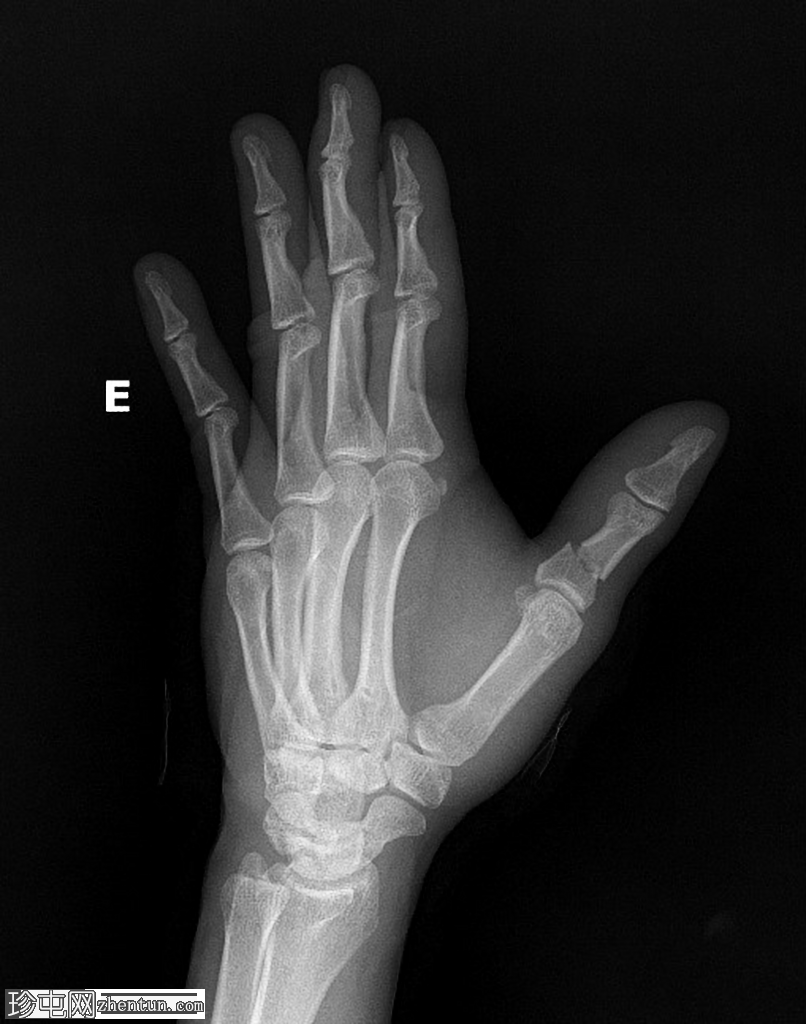 近节指骨骨折 - 拇指