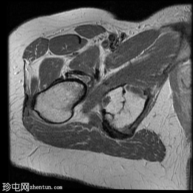 髋臼骨内脂肪瘤