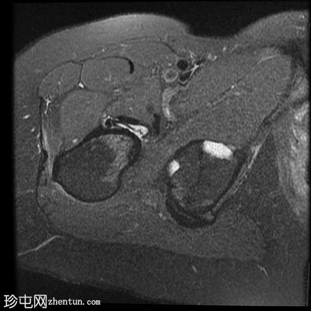 髋臼骨内脂肪瘤