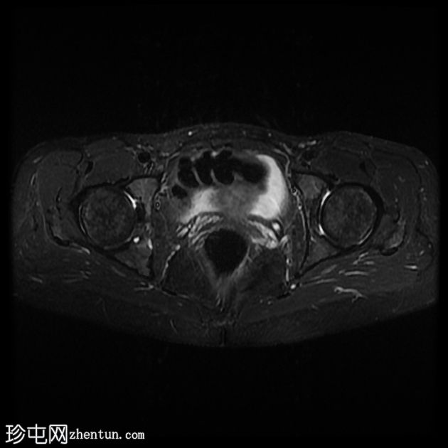 髋臼骨内脂肪瘤