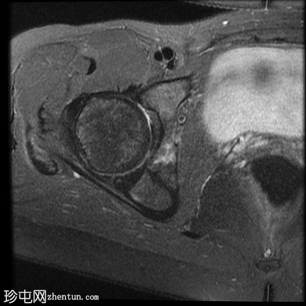 髋臼骨内脂肪瘤