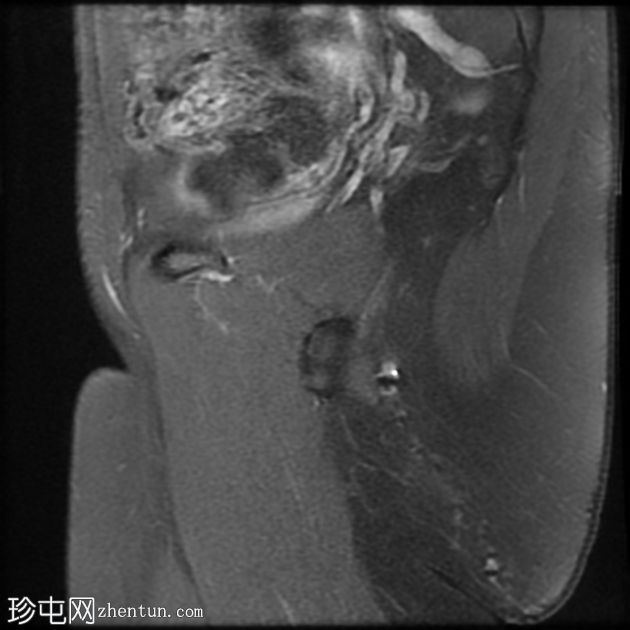 髋臼骨内脂肪瘤