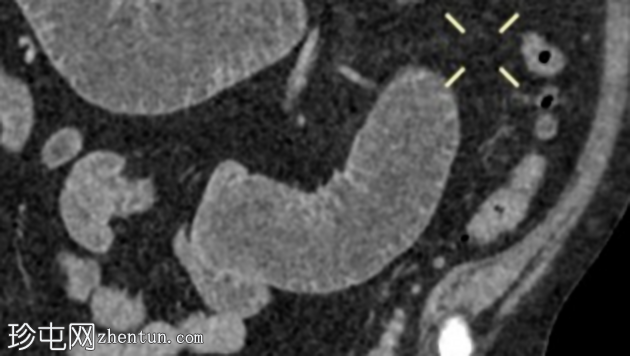胆石性肠梗阻 - 放射性胆结石