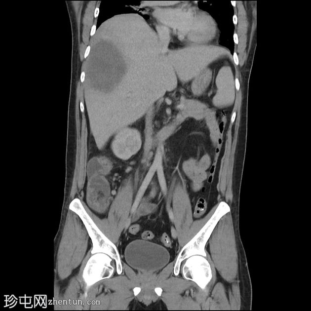 阿米巴肝脓肿