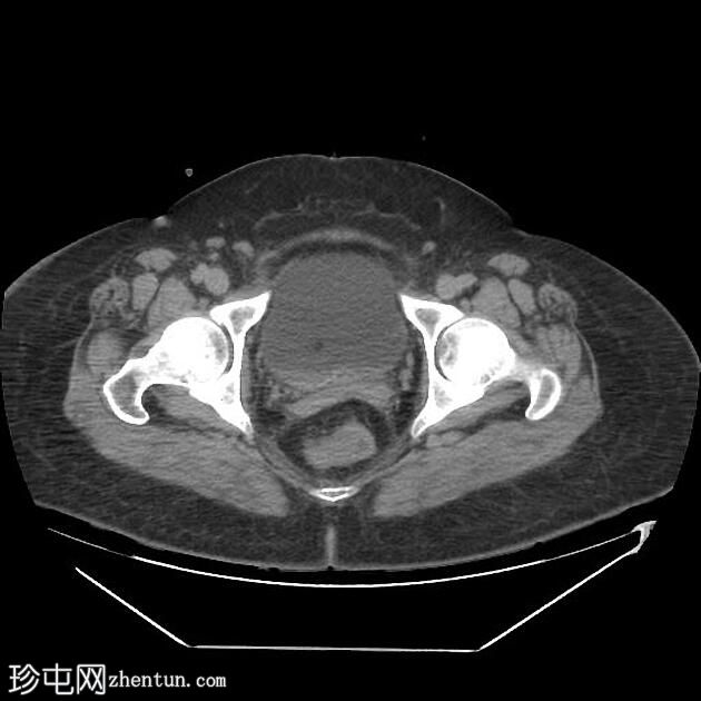 急性胰腺炎