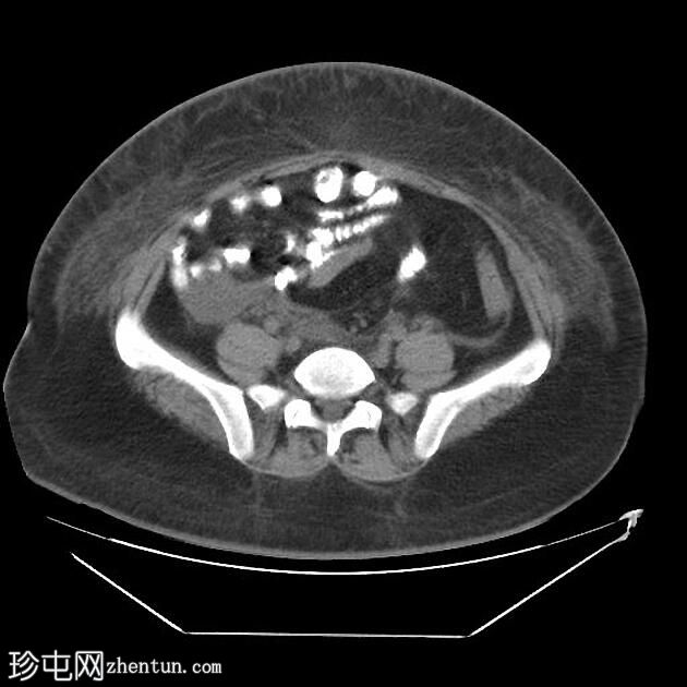 急性胰腺炎