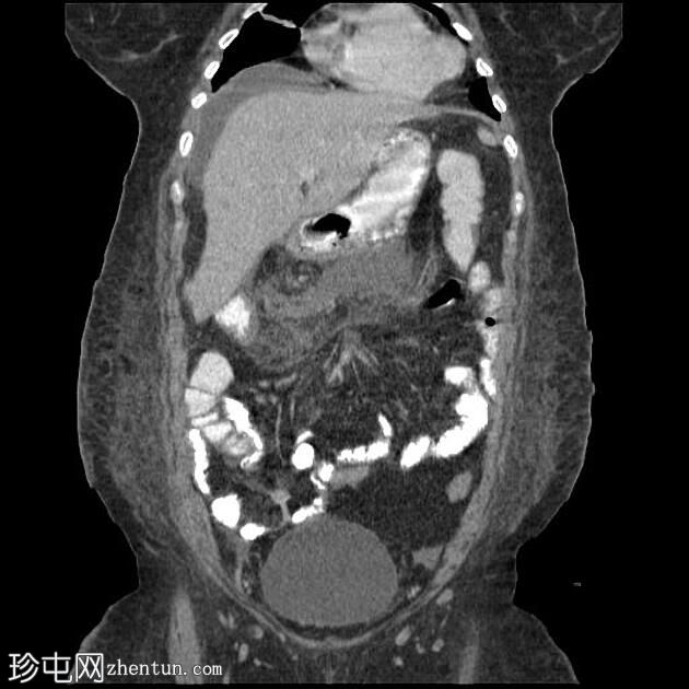 急性胰腺炎