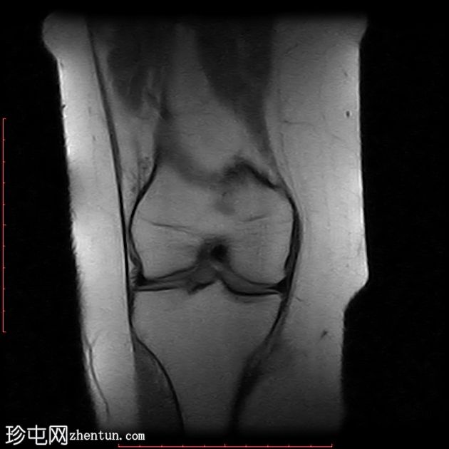 髌腱-股骨外侧髁摩擦综合征