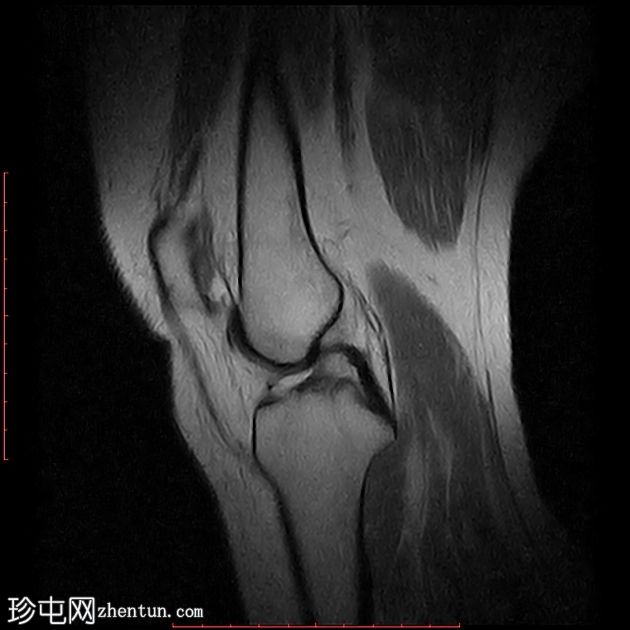 髌腱-股骨外侧髁摩擦综合征