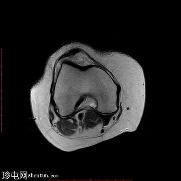 髌腱-股骨外侧髁摩擦综合征