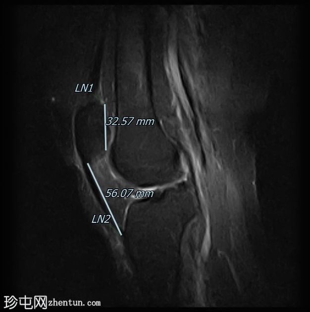 髌腱-股骨外侧髁摩擦综合征