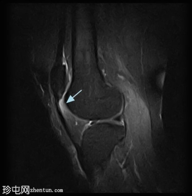 髌腱-股骨外侧髁摩擦综合征