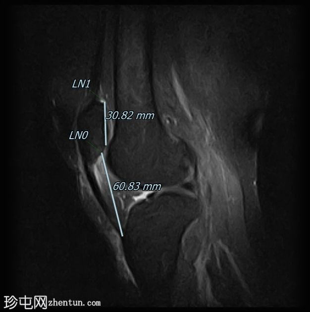 髌腱-股骨外侧髁摩擦综合征