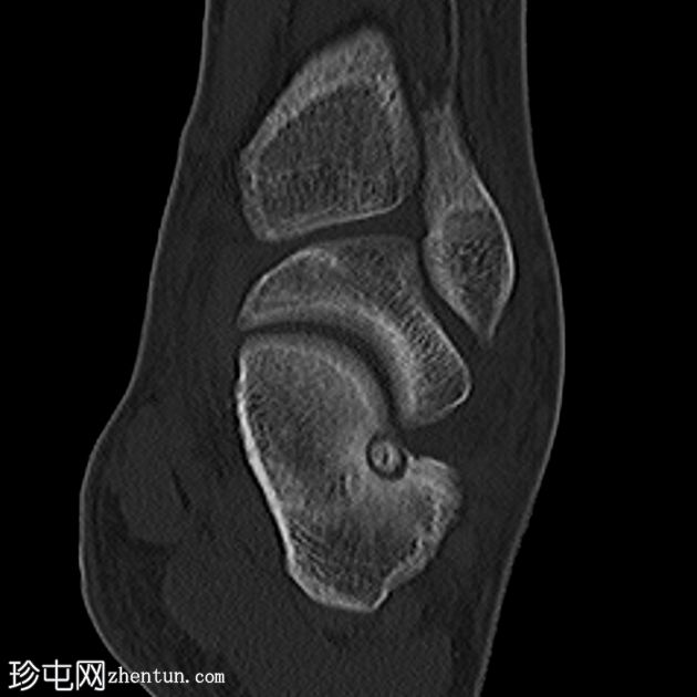 跟骨骨样骨瘤