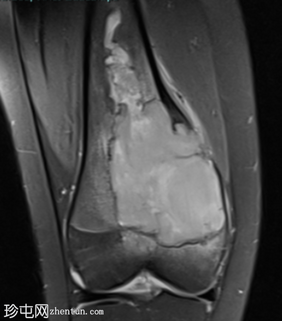 巨细胞瘤 - 股骨