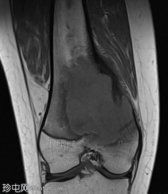 巨细胞瘤 - 股骨