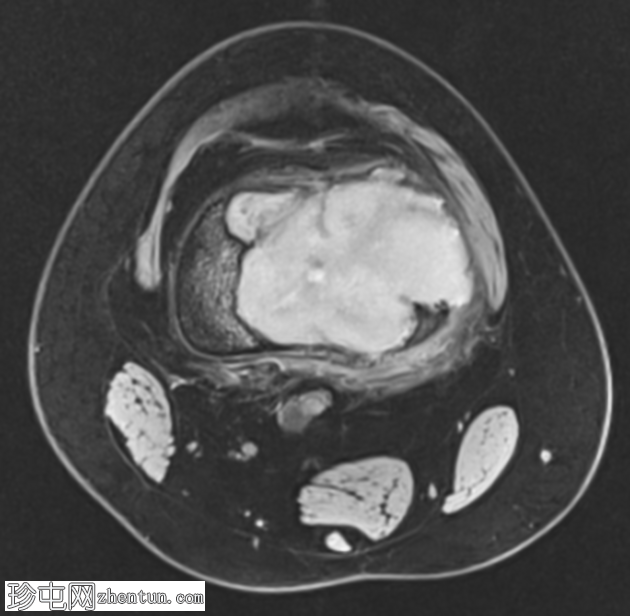 巨细胞瘤 - 股骨
