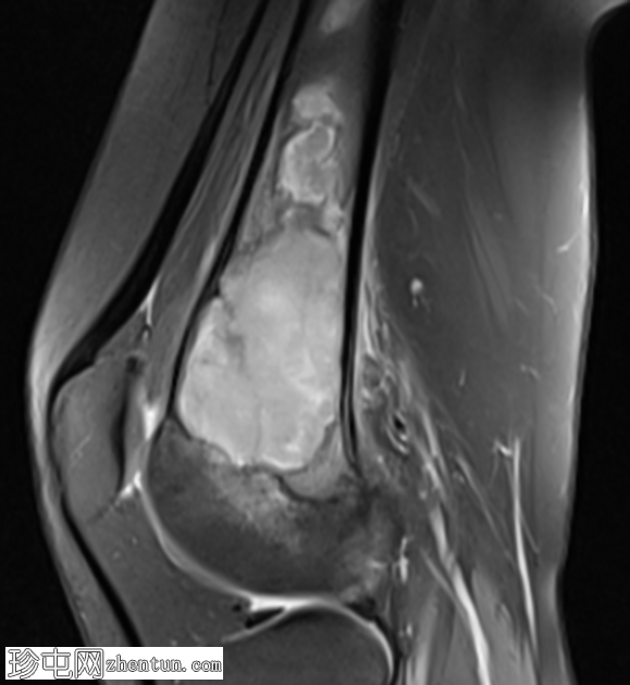 巨细胞瘤 - 股骨