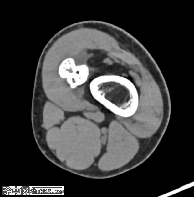 骨软骨瘤 - 股骨
