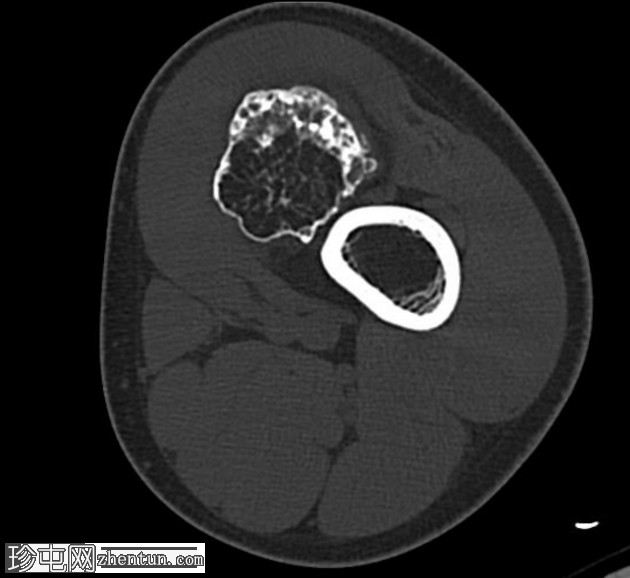 骨软骨瘤 - 股骨