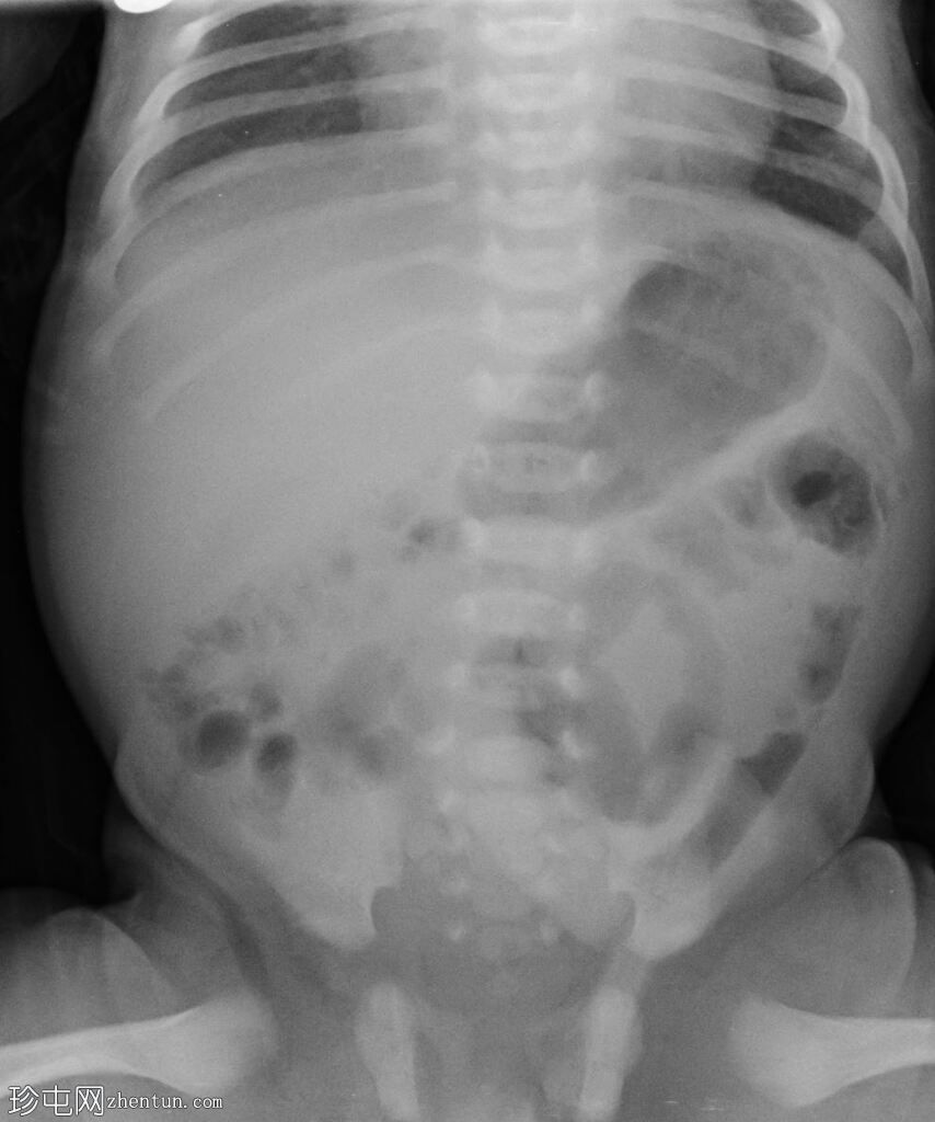 正常腹部 X 光片 - 新生儿