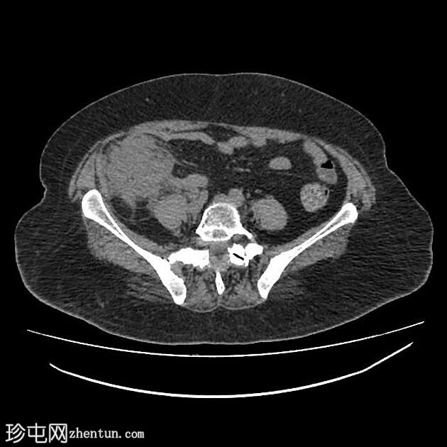 穿孔性阑尾炎伴脓肿形成