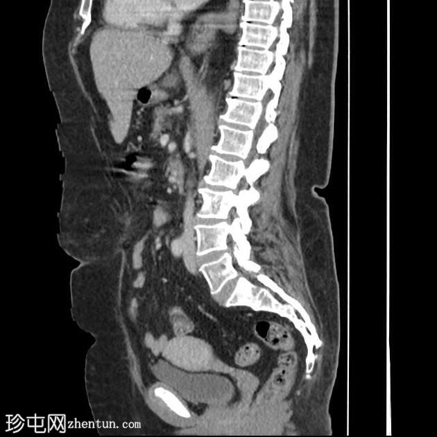 穿孔性阑尾炎伴脓肿形成