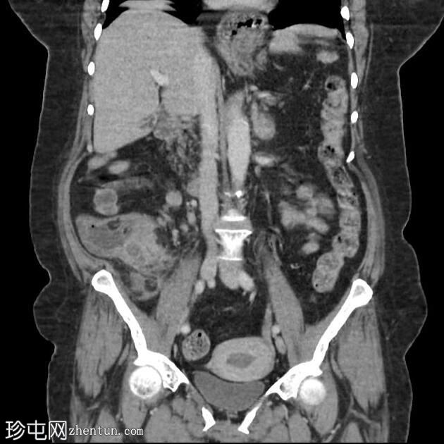 穿孔性阑尾炎伴脓肿形成