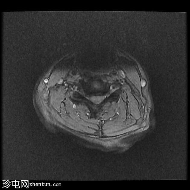 与齿突相关的慢性寰枢椎后部半脱位