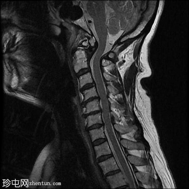 与齿突相关的慢性寰枢椎后部半脱位