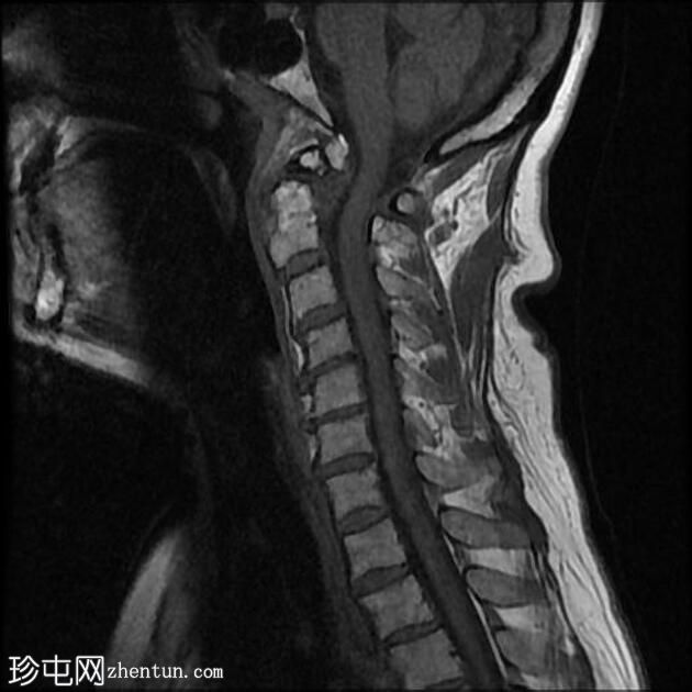 与齿突相关的慢性寰枢椎后部半脱位