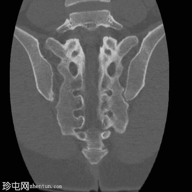 骶骨骨折