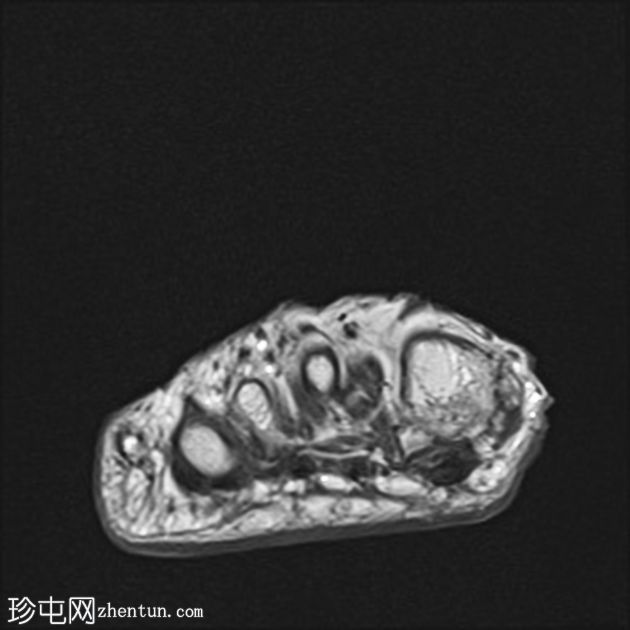 跖骨软骨下功能不全骨折