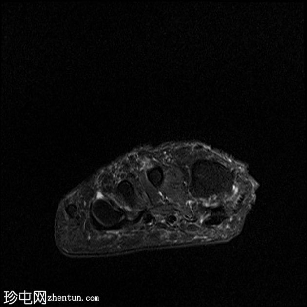 跖骨软骨下功能不全骨折