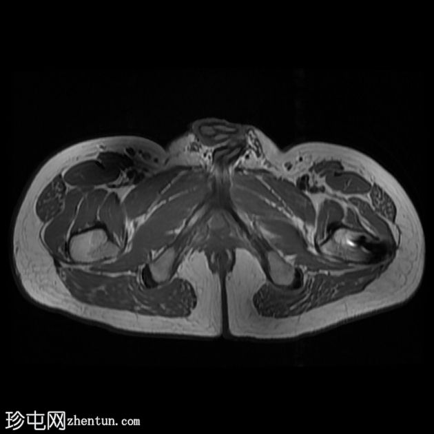 坐骨臀部滑囊炎