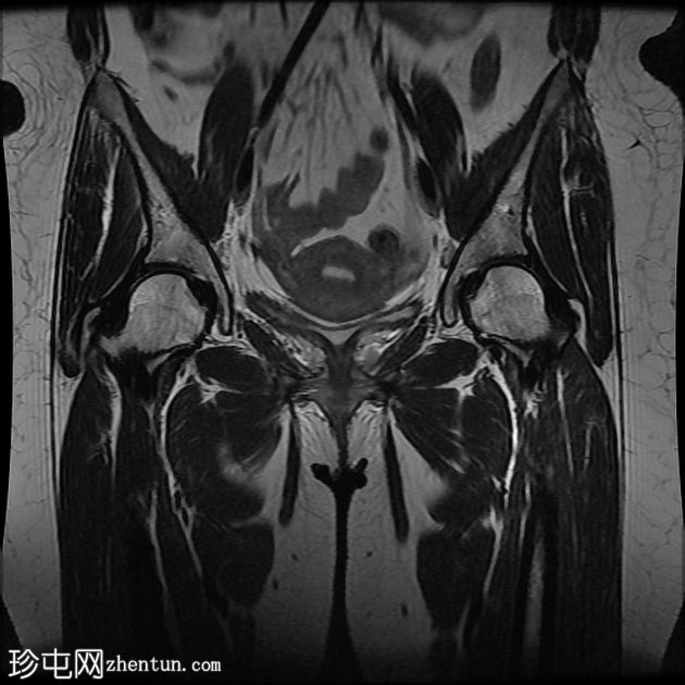 臀下肌小滑囊炎