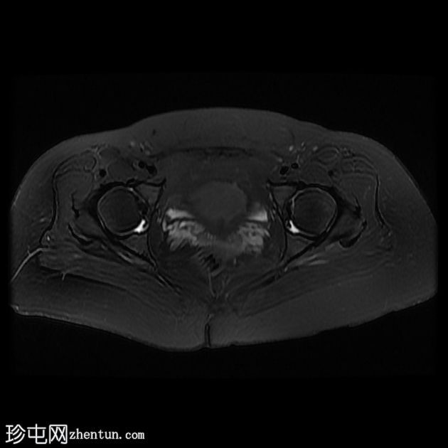 臀下肌小滑囊炎