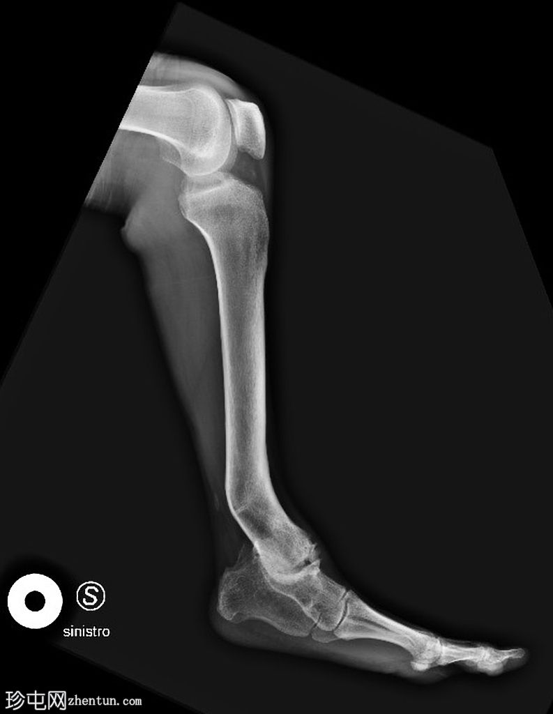 双侧腓骨半肢畸形 - Achterman 和 Kalamchi 2 型