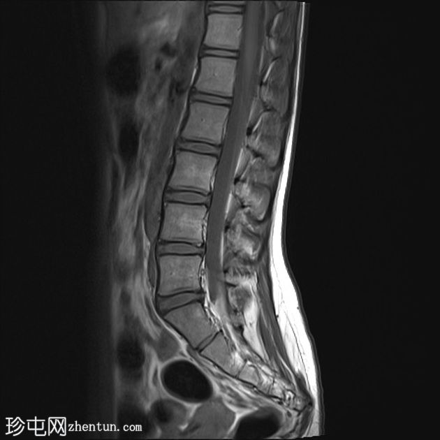 正常MRI腰骶椎