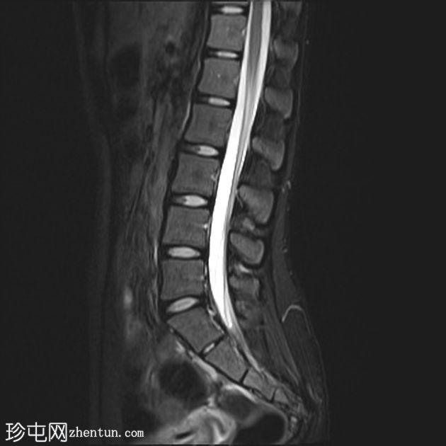正常MRI腰骶椎