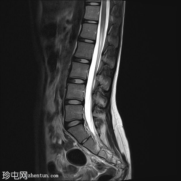 正常MRI腰骶椎