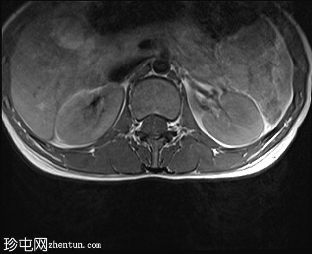 正常MRI腰骶椎