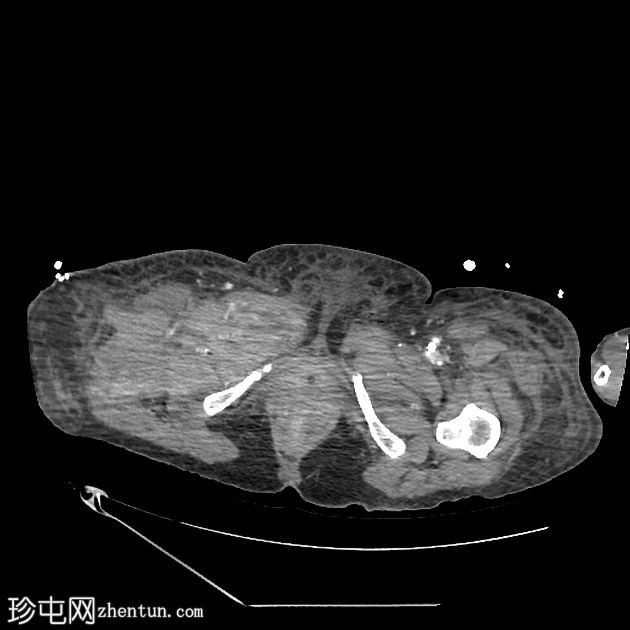 坏死性筋膜炎