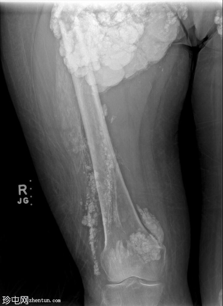 与肿瘤性钙质沉着症相关的股骨骨折