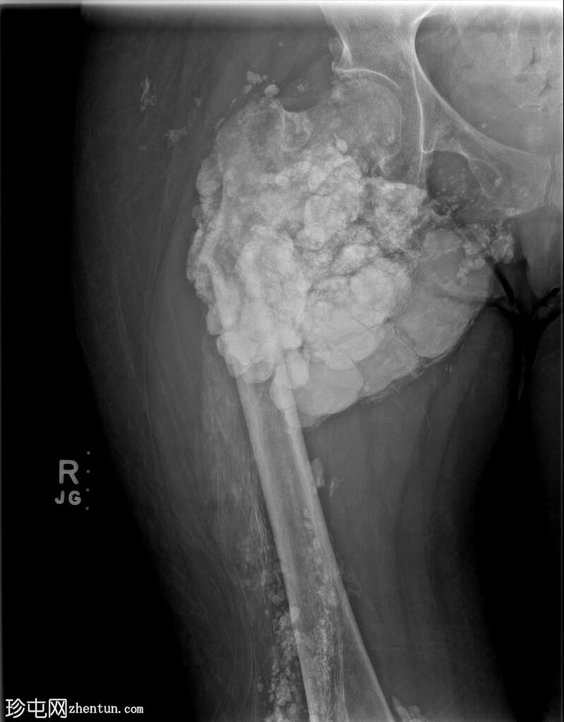 与肿瘤性钙质沉着症相关的股骨骨折