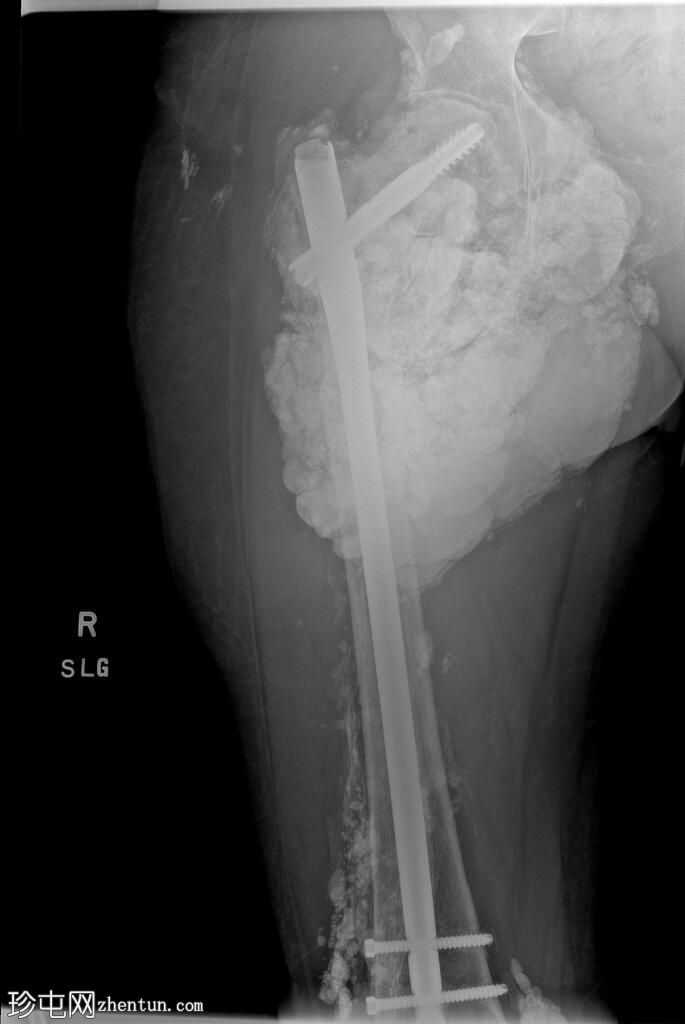 与肿瘤性钙质沉着症相关的股骨骨折