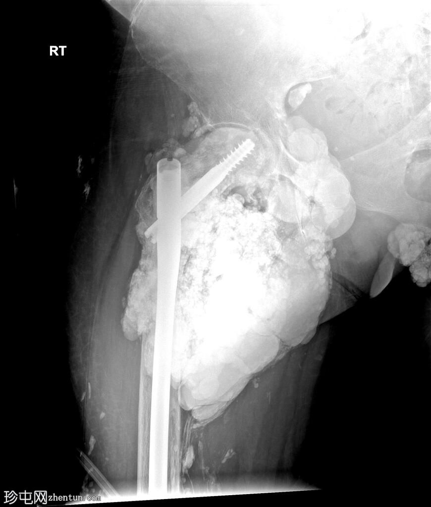 与肿瘤性钙质沉着症相关的股骨骨折