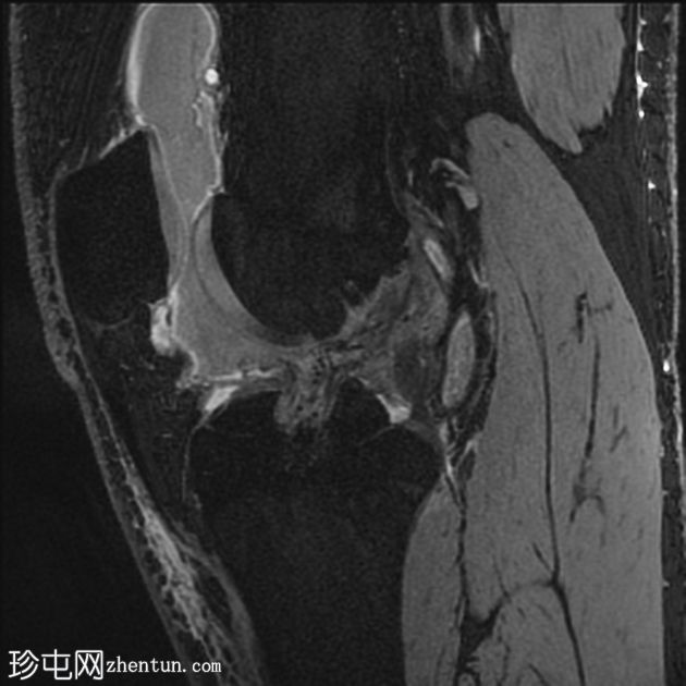 前交叉韧带移植物撕裂伴斜坡病变