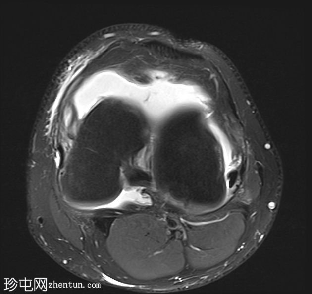 前交叉韧带移植物撕裂伴斜坡病变